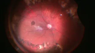 Vitrectomy for Subsilicon ERM removal | Sub Silicon ERM | Dr Manish Nagpal