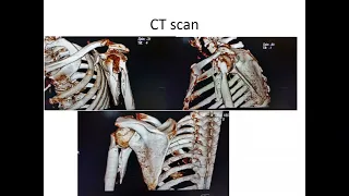 Prof Steve Roche- Fractures around the shoulder 2022