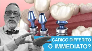 Impianti dentali: carico immediato o differito?