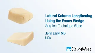 Dr. John Early - Lateral Column Lengthening Using the Evans Wedge - CONMED Surgical Technique