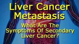 Liver Cancer Metastasis: What Are The Of Secondary Liver Cancer?