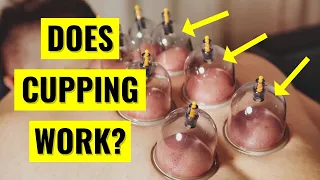 Does Cupping Therapy Actually Work?