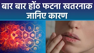 बार बार होंठ फटने का क्या कारण है, बार बार होंठ क्यों फटते है |Boldsky*Health