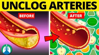 Top 10 Foods to Clean Your Arteries that Can Prevent a Heart Attack