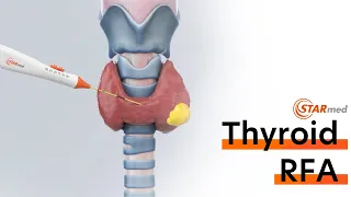 Thyroid Radiofrequency Ablation(RFA) Procedure