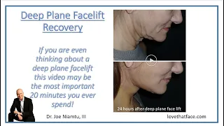 Deep Plane Facelift Recovery:  Watch this video if you are even thinking about having a facelift.