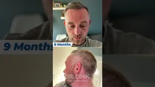 Dr.Cinik Hair Transplant | Before After | Hair Growth Results in 1 Year