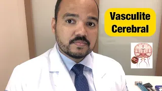 Vasculite cerebral