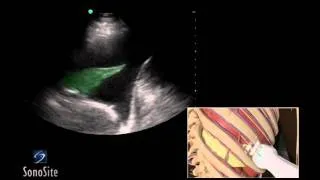 How To: Ultrasound Guided Thoracentesis Exam 3D Video