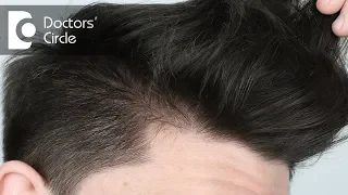 What causes hair loss in teenage boys with parents having good hair? - Dr. Rashmi Ravindra