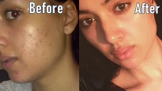 IS BENZOYL PEROXIDE GOOD FOR ACNE? | HOW I CLEARED MY ACNE FAST | | BEFORE AND AFTER RESULTS!