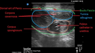 Penile fracture on ultrasound