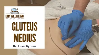 Dry Needling Gluteus Medius