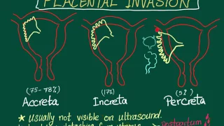 Placental Invasion (Placenta Accreta, Increta and Percreta) mnemonic