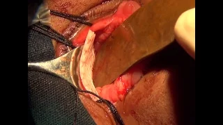 Orbital blow out fracture with polycaprolactone implant Soosan Jacob with audio 2 3 min