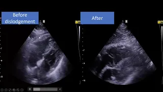 Important trick in CCE [difference between critical care Echo and cardiac Echo study]