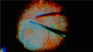 Extracción de lente intraocular luxada en cámara vítrea. Centro de Oftalmología Bonafonte.Barcelona.