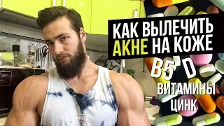 Как избавиться от Прыщей НАВСЕГДА? (Лечение АКНЕ, Черных точек)