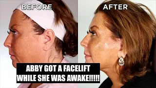 ABBY LEE MILLER GOT A FACELIFT WHILE SHE WAS AWAKE!! Let’s Chat