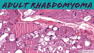 Adult Rhabdomyoma for Pathologists