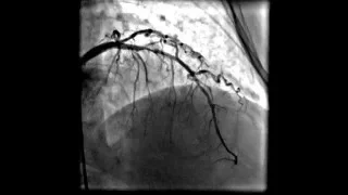 Acute anterior wall myocardial infarction