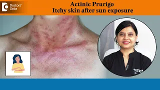 Can you be allergic to sunlight?|Actinic Prurigo|Itchy skin in summer-Dr.Amee Daxini|Doctors' Circle