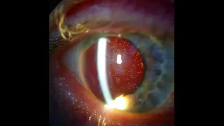 Silicone Oil in an Aphakic eye