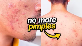 This is WHY You're Getting Pimples | Men's Skincare Tips