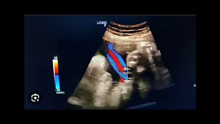 3 vessel cord means boy or girl | 2 vessel cord means ! | The umbilical cord ultrasound in urdu