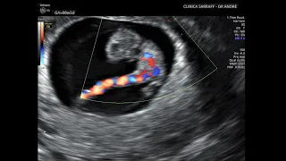 ARTÉRIA UMBILICAL ÚNICA - CORDÃO UMBILICAL - CLÍNICA SARRAFF CURITIBA - DR ANDRÉ SARRAFF CRMPR 24565