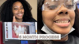 MY INVISALIGN JOURNEY | 6 MONTH UPDATE, CRAZY BEFORE & AFTER, I BROKE AN ATTACHMENT