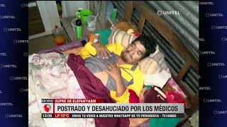 El hombre de 40 años que sufre de elefantiasis fue desahuciado por los médicos