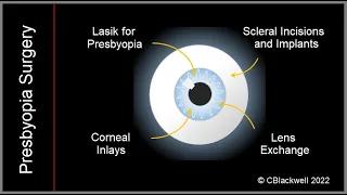 Presbyopia 3: New Treatments with Surgery