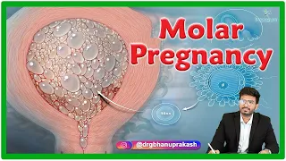 Molar Pregnancy : Causes, Clinical manifestations, Diagnosis, and Treatment