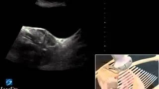 3D-пособие: Ультразвуковое исследование органов таза у женщин -- ультразвуковая система SonoSite