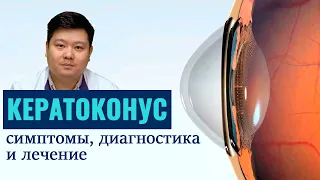 Кератоконус: признаки, причины возникновения и лечение