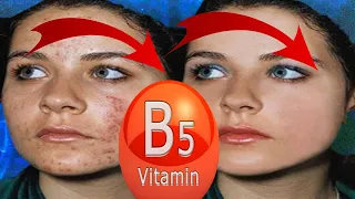 5 Amazing Benefits of Vitamin B5 Pantothenic Acid for Acne, Oily Skin & Face