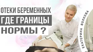 Отеки беременных, где границы нормы? Здоровье женщины. Гинекология.