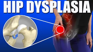 Hip Dysplasia l (Developmental Dysplasia of Hip l Pain Relief Exercises l Causes l Diagnosis)