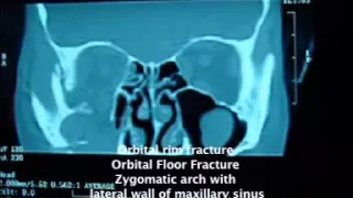 SV1526 Tackling the Spectrum of Orbital Floor Fractures