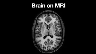 Anatomy of the Brain on MRI