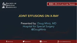 Joint Effusions on X-Ray