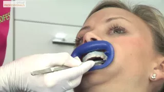 Bleaching / Zahnaufhellung - Zahnarzt Dr. Komma, Nidderau - Smile Professionals