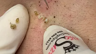 Blackhead Removal - Satisfying Extractions