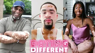 Trying To Find Love With Vitiligo | DATING DIFFERENT