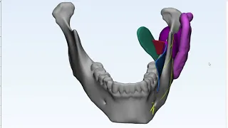 Pterygomandibular Space