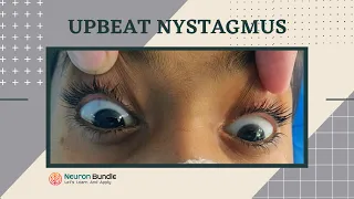 nystagmus : eye movements l demo on a patient l horizontal & vertical nystagmus #neurology