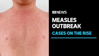 Measles cases are on the rise around the world | ABC News