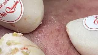 |503| Blackheads & Acne treatment 10/10/2022