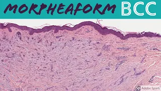 Morpheaform Basal Cell Carcinoma: 5-Minute Pathology Pearls